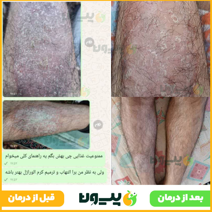 درمان پسوریازیس