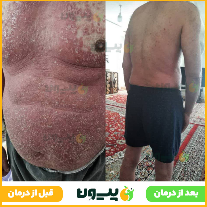 درمان پسوریازیس