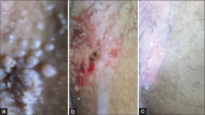 Before and after laser genital warts