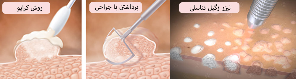 genital warts treatment methods