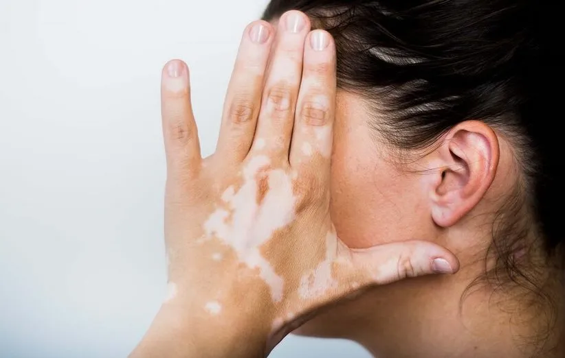 Vitiligo
