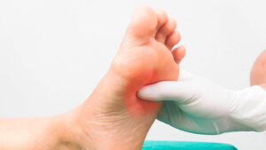 درمان زخم پای دیابتی دکتر روازاده