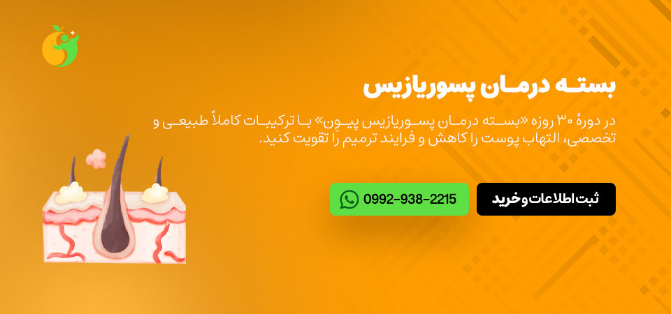 درمان پسوریازیس