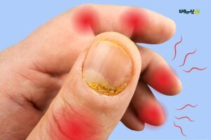 psoriatic arthritis nail symptoms NOLOGO