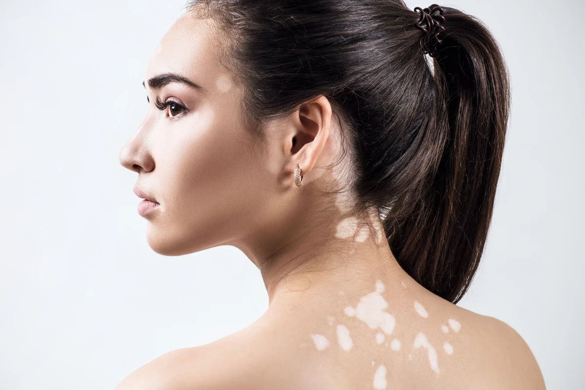 درمان بیماری پیسی